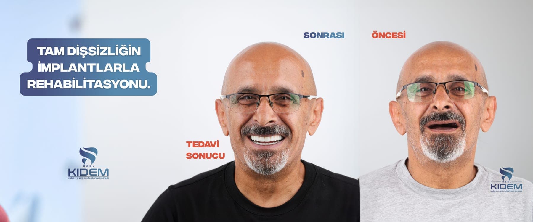 Tam dişsizlik ve implant rehabilitasyonu