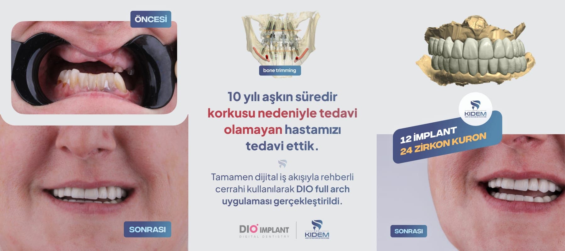 Dijital rehberli cerrahi planlama