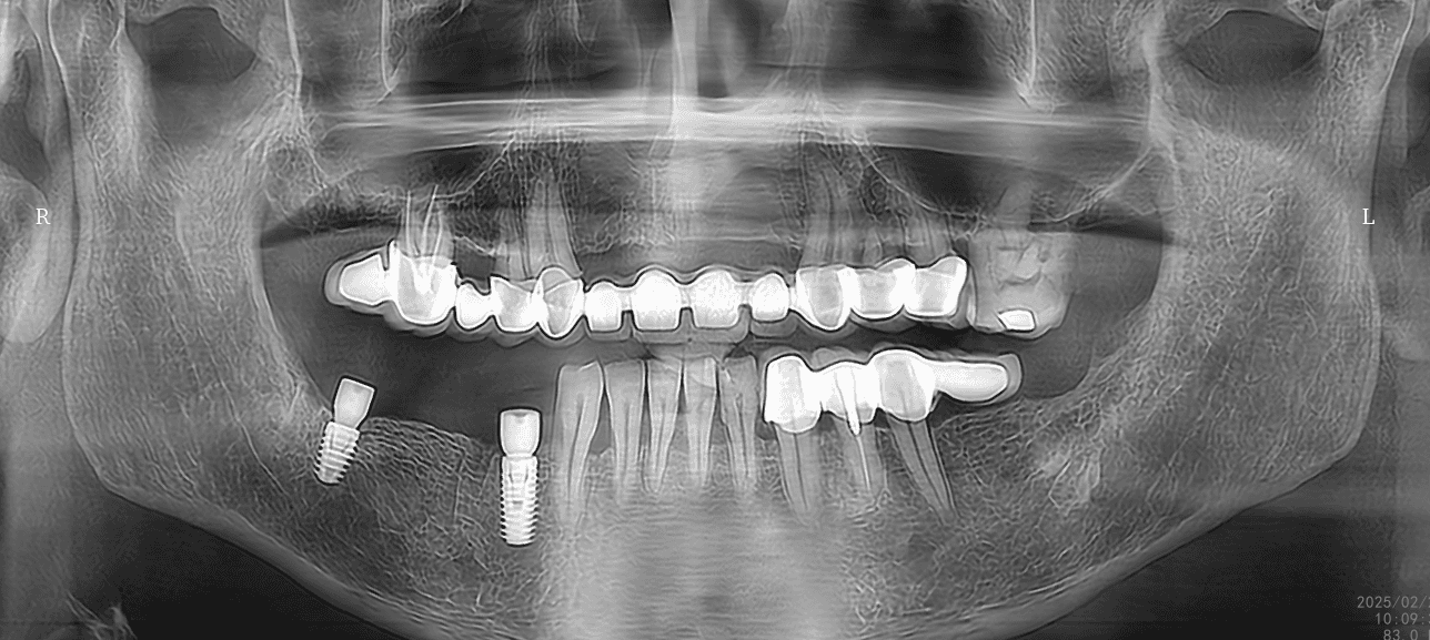 Alt çene implant yerleşimi