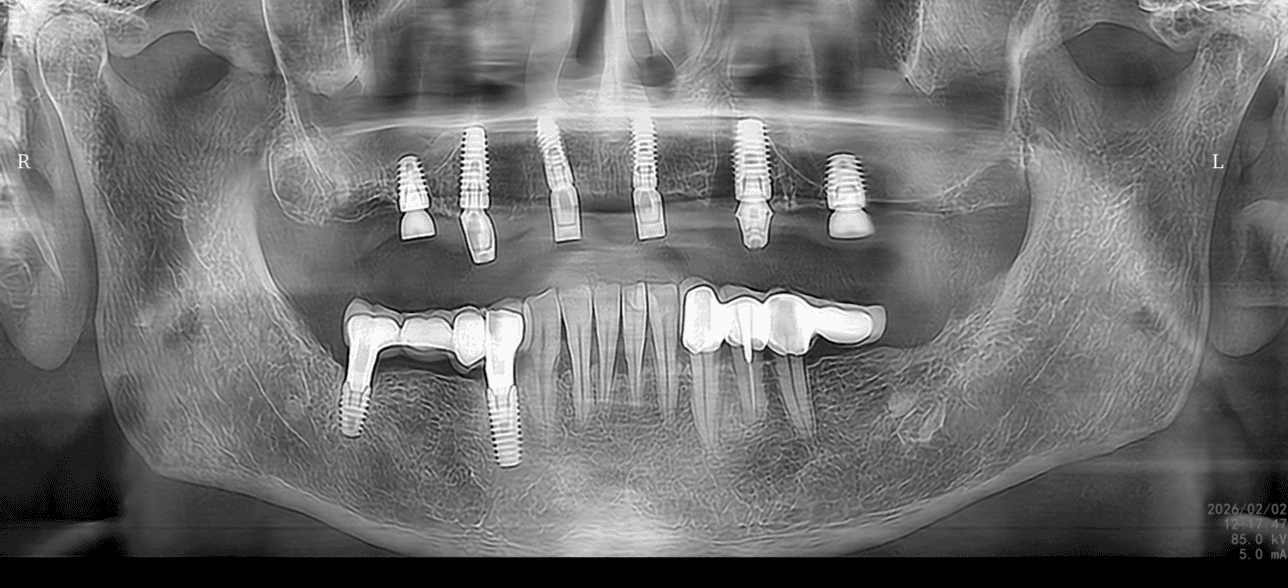 Üst çene implant yerleşimi